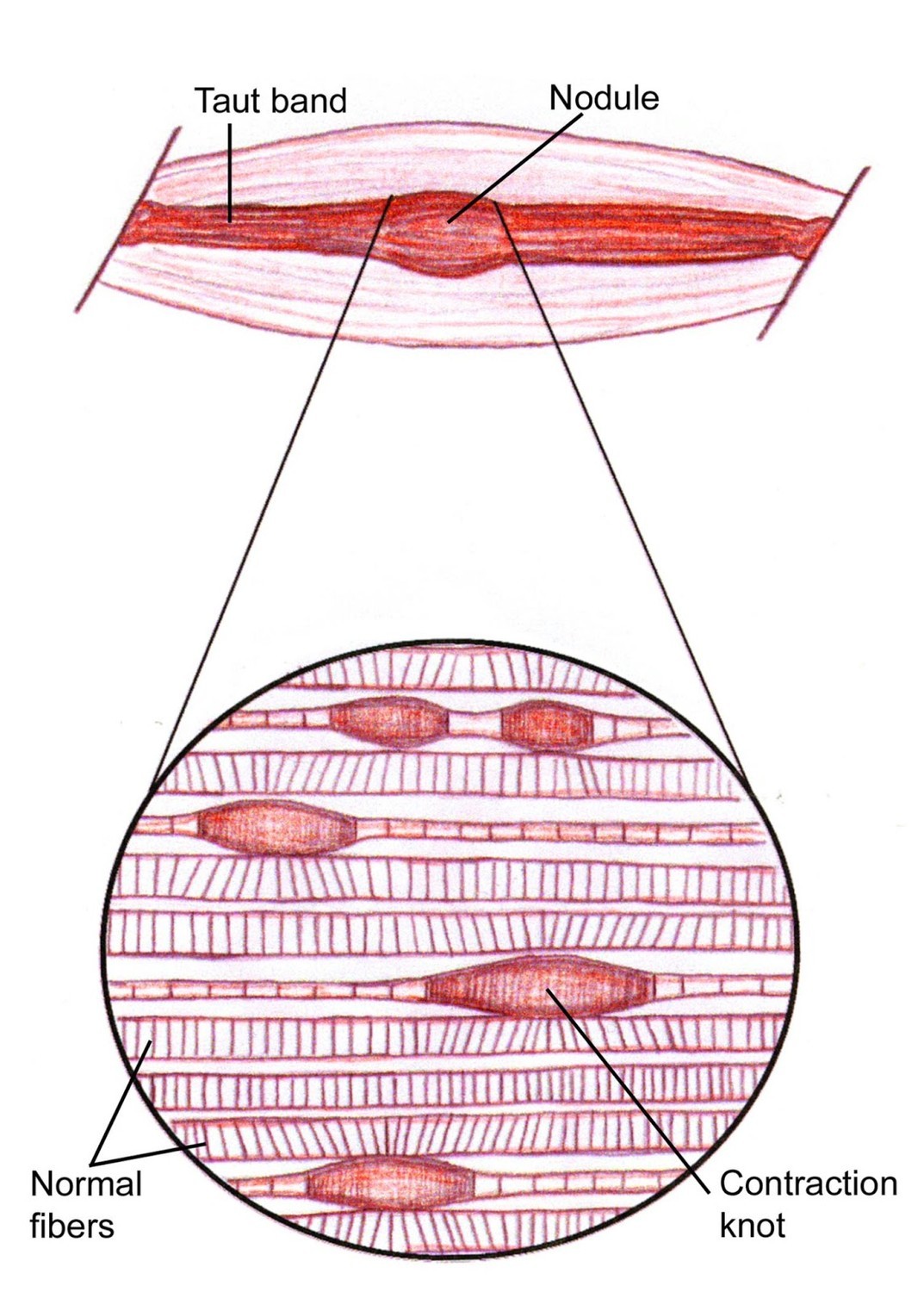 Image of a Trigger Point in a Muscle